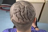 Bloke with 'brain growing outside his head' undergoes year of weird surgeries to fix it