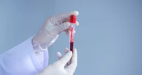 Simple blood test could predict risk of type 2 diabetes in patients, study finds