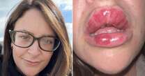 Woman horrified as filler to 'fix' top lip leaves her with hugely swollen mouth