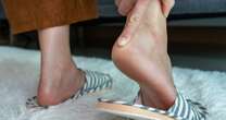 Little-known skin cancer symptom that shows up on toenails