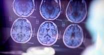 Alzheimer's risk linked to 'surprising' STI with painful symptoms, study warns