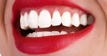 Best teeth whitening gels for 2021 that will help you get a bright white smile