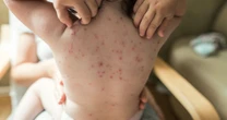 Early signs of chickenpox parents need to be on high alert for this winter - full list