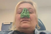 'I thought nosebleeds were hay fever but now my nose has been amputated'
