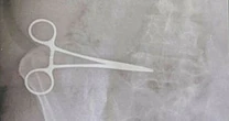 Mum-of-seven in agony after tummy tuck is told scissors were left inside by surgeon