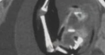 Doctors discover one-year-old girl has foetus growing in skull that was her twin sister