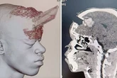 Builder miraculously survives as wooden stake is driven into his skull in freak work accident