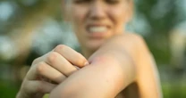 Stop mosquito bite itch instantly with this simple spoon hack which is backed by science