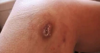 Woman left with black hole burned into her leg after falling asleep on phone chargerHorrific injuries