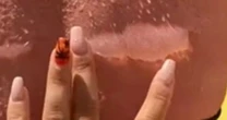 Horrific sunburn leaving woman in blisters acts as stark warning to use suncream this summer