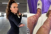 Teenager's 'veins burst leaving her in wheelchair' after rare reaction to Covid vaccine