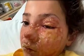 Girl, 10, left with skin 'melting' off her face from microwave squishy toy trend