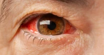 Eleven warning signs of cancer you can see in your eyes - from dark spots to pale lumps