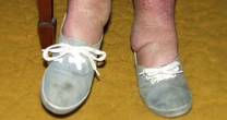 Heart disease risk factor determined by your socks and ankles – signs to spot