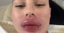 Influencer has severe allergic reaction to lip filler removal