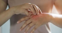 Eczema in children could be treated with vaccine 'within years' after major breakthroughEczema