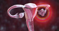 opinion'Stem cell breakthrough offering hope to women with polycystic ovary syndrome'