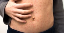 'Devastating' measles warning as illness skyrockets in UK and doctors 'living in fear'