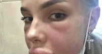 'I nearly died having lip filler removed - they were bursting after allergic reaction'