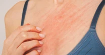 Warning over nine common signs that an insect bite could be life-threatening and how to tellInsects