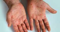 Mpox: Eighth case of new 'most dangerous yet' strain detected in the UK