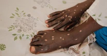 Mpox sufferer details painful symptoms to look for as horror virus continues to spread