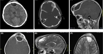 'Harmless pimple' on little girl's head grew into a life-threatening swelling
