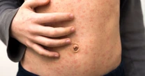 Measles symptoms to know after UK outbreak - including rash and four other 'early' signsMeasles