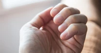 Subtle sign on your nail bed could be symptom of rare skin cancerSkin cancer