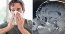 Man, 20, with a constant runny nose finds out his brain was poking out and 'leaking'