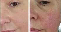 'A godsend product that's made me feel confident again' £8 BB cream blurs lines and hides redness