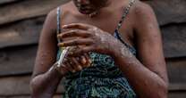 Travel expert’s advice to avoid Mpox as deadly infection continues to spreadCentral Africa