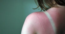 Dermatologist urges Brits to avoid sunburn 'hack' that makes pain a lot worse