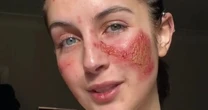 'I'm so allergic to myself it feels like I'm burning after just laughing - doctors are baffled'
