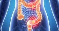 opinion'Bowel cancer trial sees all patients disease-free'