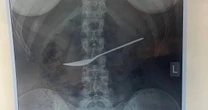 Girl complaining of tummy ache has 8 inch spoon removed from stomach baffling doctors