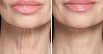 Beauty buffs rave about non-surgical instant fix for ‘turkey neck’ that makes an ‘amazing difference’