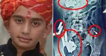 Boy, 15, dies after surgeons remove 56 metal items from stomach including razor blades