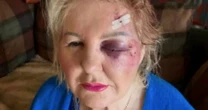 'I've been left partially blind after trip and fall - it nearly killed me'