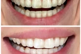 The £20 'dentist-approved' teeth whitening product that will fit into your holiday luggage