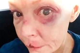 TV presenter Gail Porter suffers bruising and scars after horror fall at London Tube station