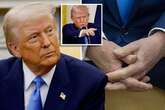 Donald Trump health fears over mark on hand as doctor weighs in his 'dark skin'