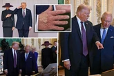 Donald Trump sparks new heath fears with mysterious white patch on hand during UK state visit