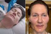 Biohacker who transferred son's blood to stay young shares face after fat injection