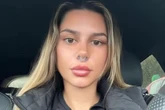 Party girl left with huge hole after nose 'fell out' from ketamine habit