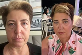 'Bags under my eyes ashamed me into £3,800 on eyelift surgery – Now I never wear shades'