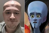 Balding man transforms into 'Megamind' after severe hair transplant side effect