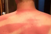 Man suffers epic sunburn fail after wife's minimal efforts to rub lotion on back