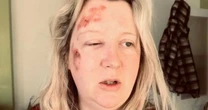 Mum's horror injuries after being set upon by teens as she returned from nursery