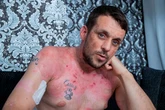 Man burned alive at horror house party fears he will "never hold son again" after injury hell